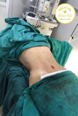 Nên hay không nên đi spa giảm mỡ bụng sau sinh? 2 giam mo bung sau sinh