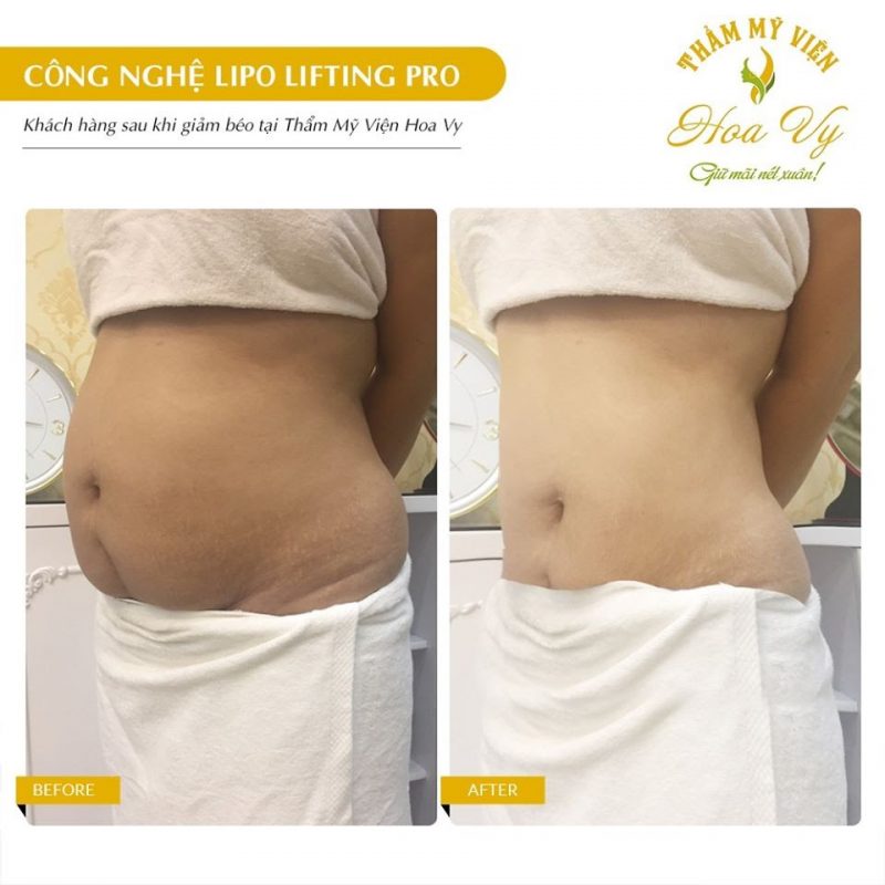 Nên hay không nên đi spa giảm mỡ bụng sau sinh? 1 giam mo bung sau sinh