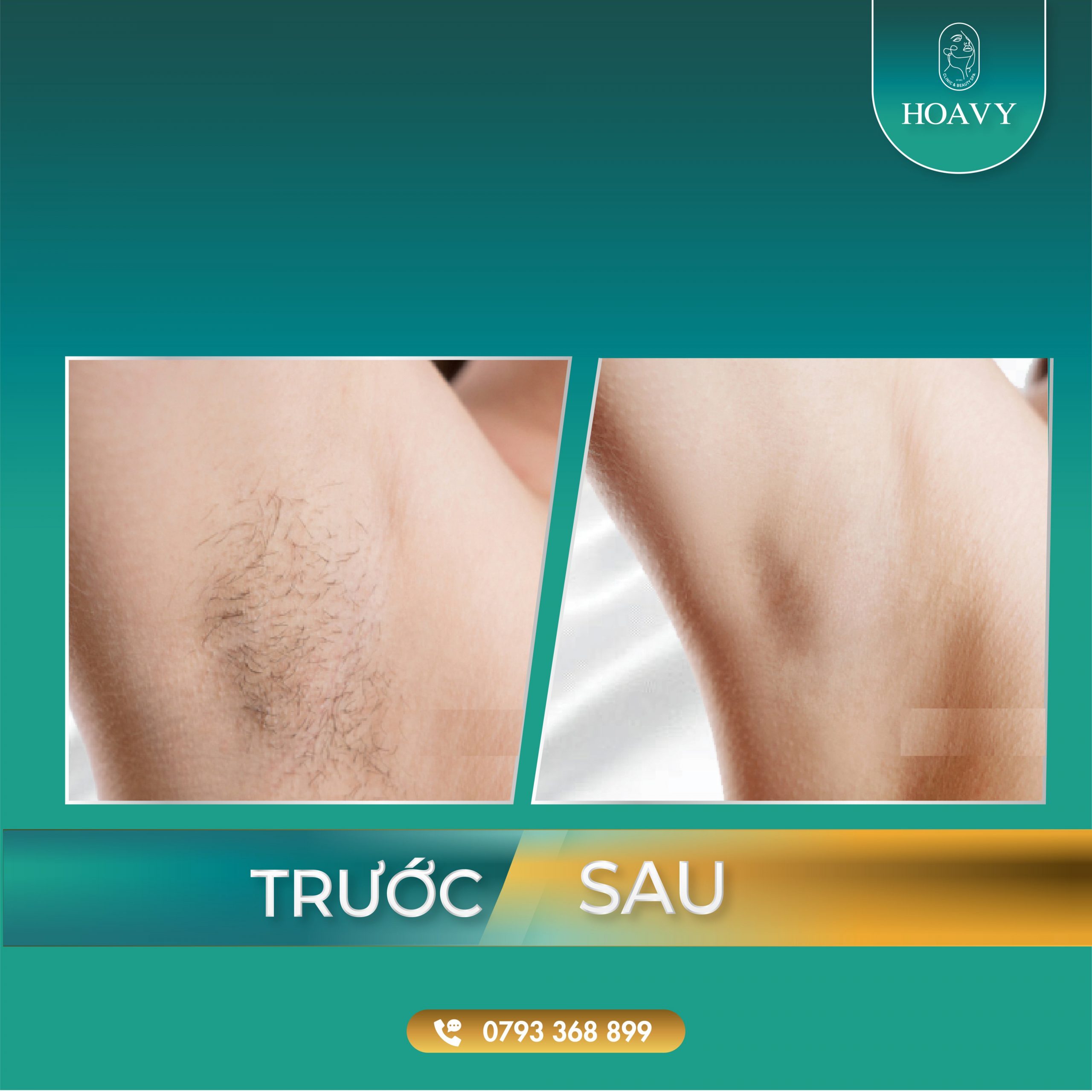 thammyhoavy.vn- dich vu ttriet long vinh vien tre hoa lan da- triet long hai phong- triet long quang ninh 3