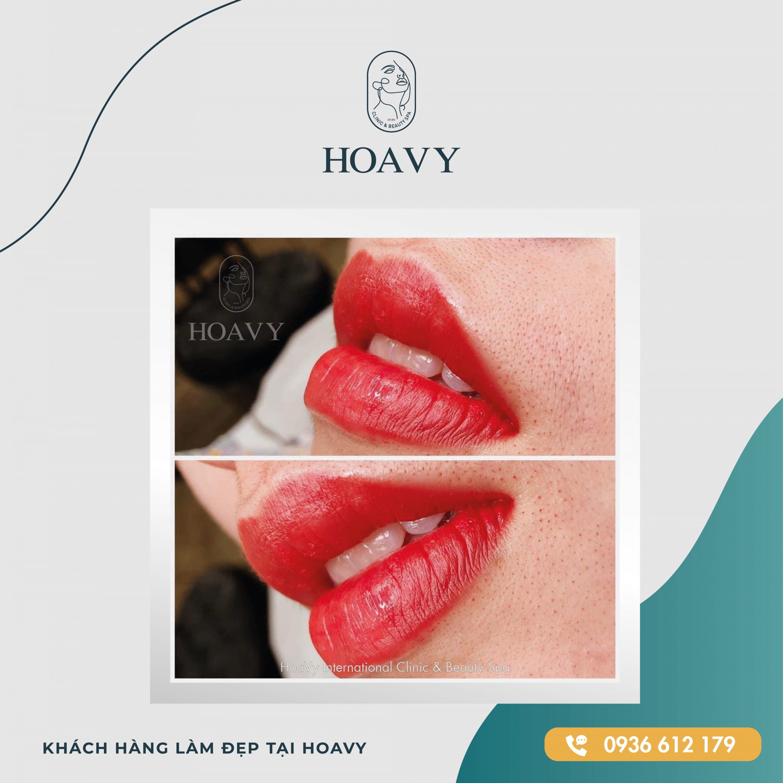 thammyhoavy.vn hinh anh khach hang lam dep moi tai hoa vy hai phong quang ninh scaled