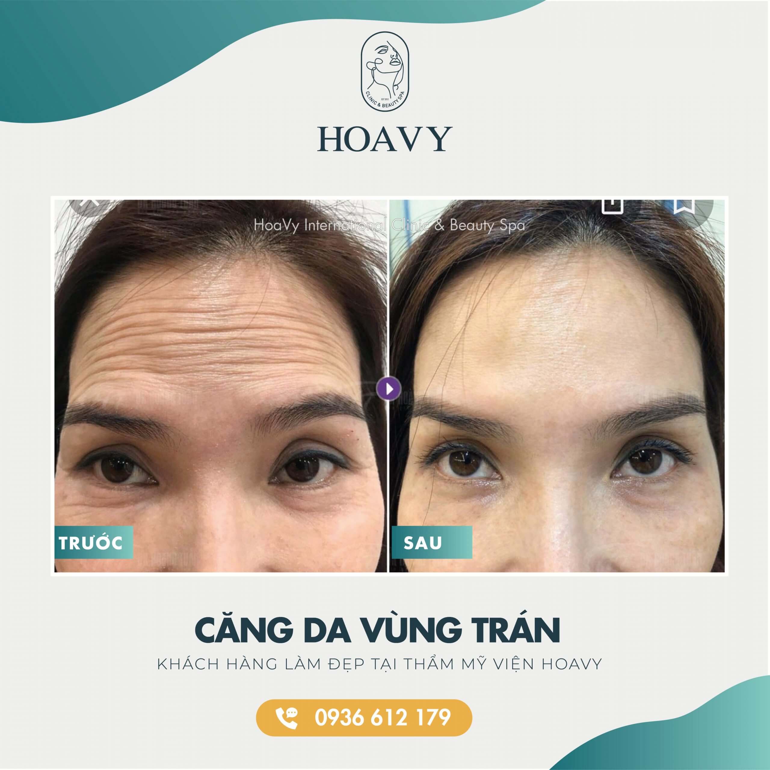 thammyhoavy.vn- hinh anh khach hang lam dep tai hoa vy hai phong quang ninh- cang da vung tran