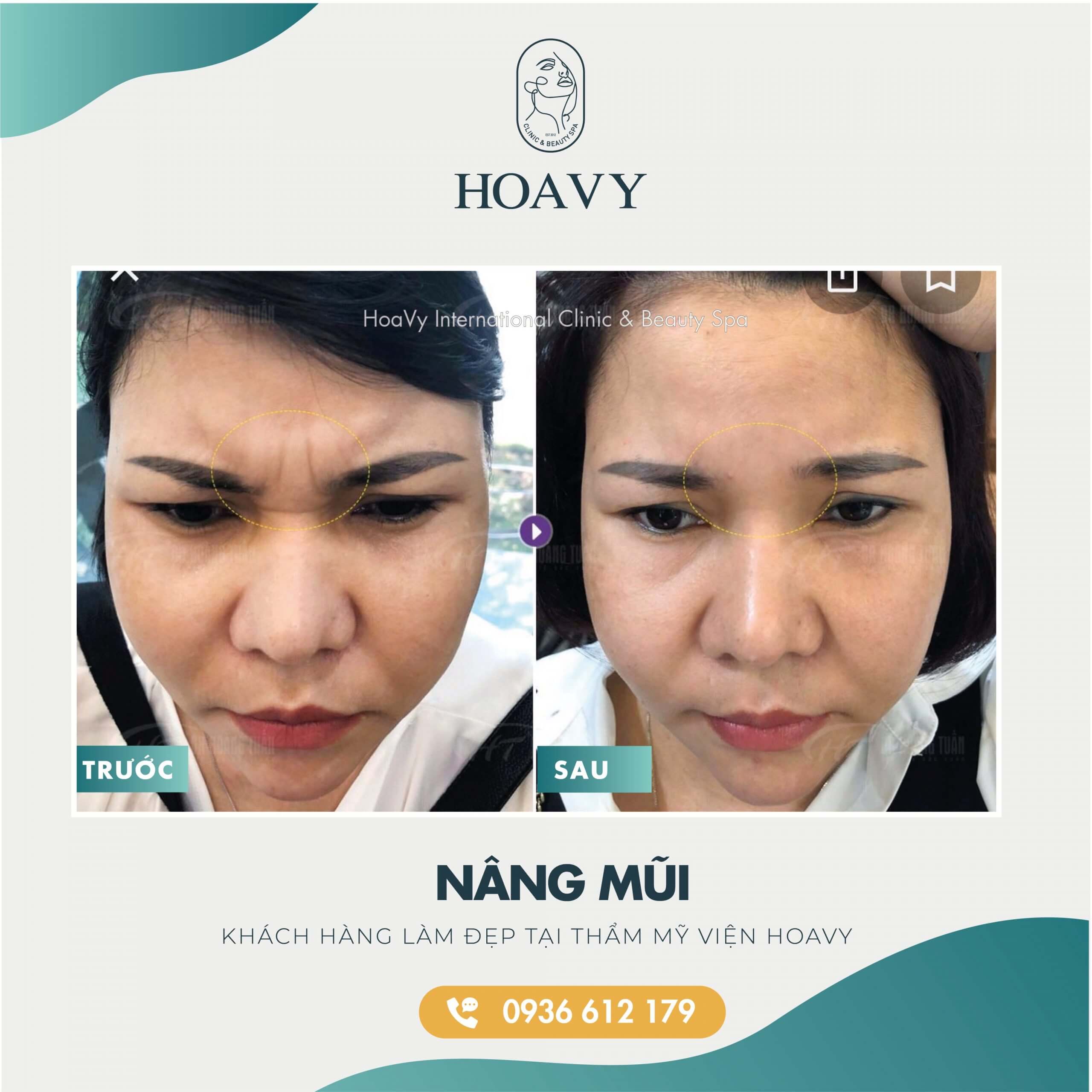 thammyhoavy.vn- hinh anh khach hang lam dep tai hoa vy hai phong quang ninh- nang mui