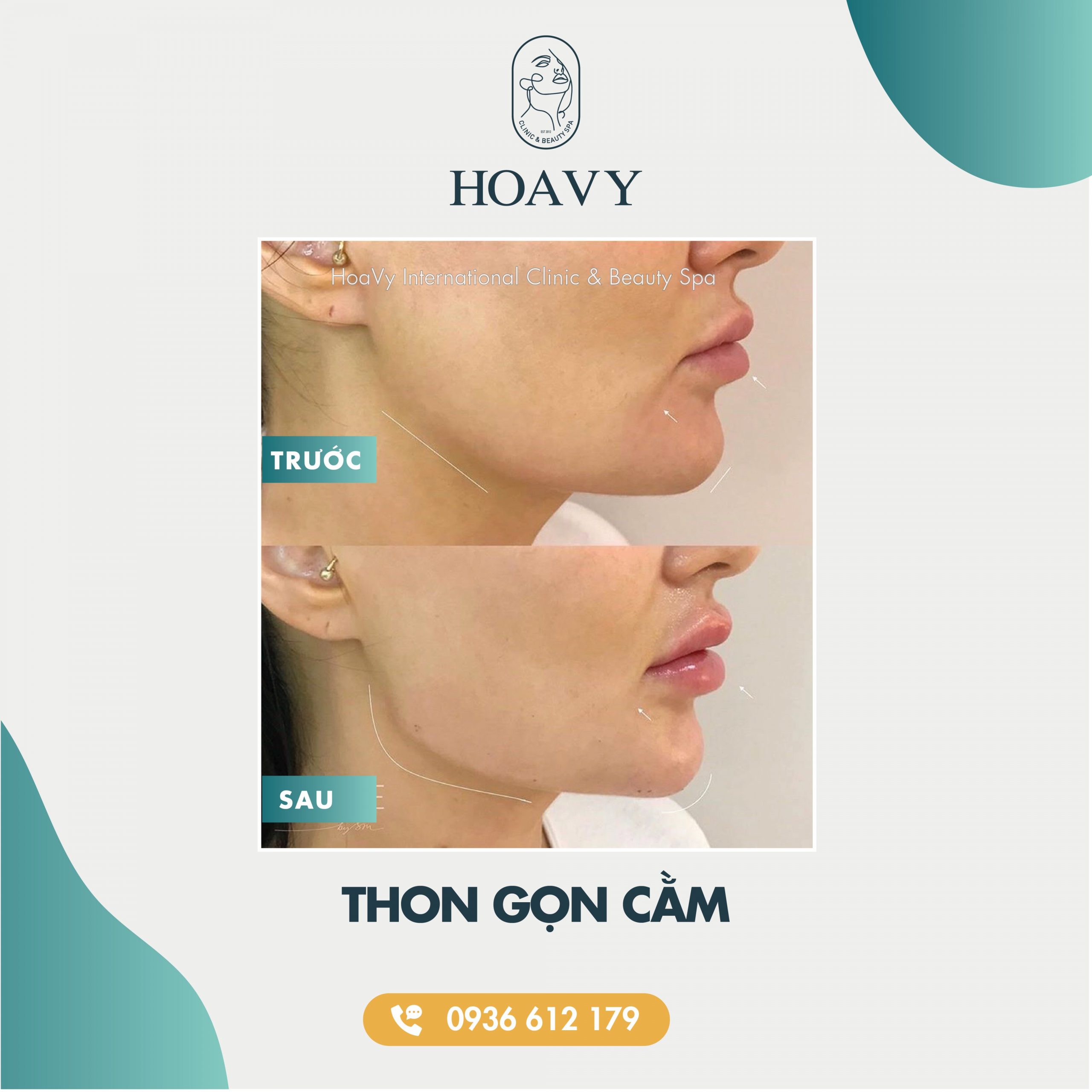 thammyhoavy.vn- hinh anh khach hang lam dep tai hoa vy hai phong quang ninh- thon gon cam