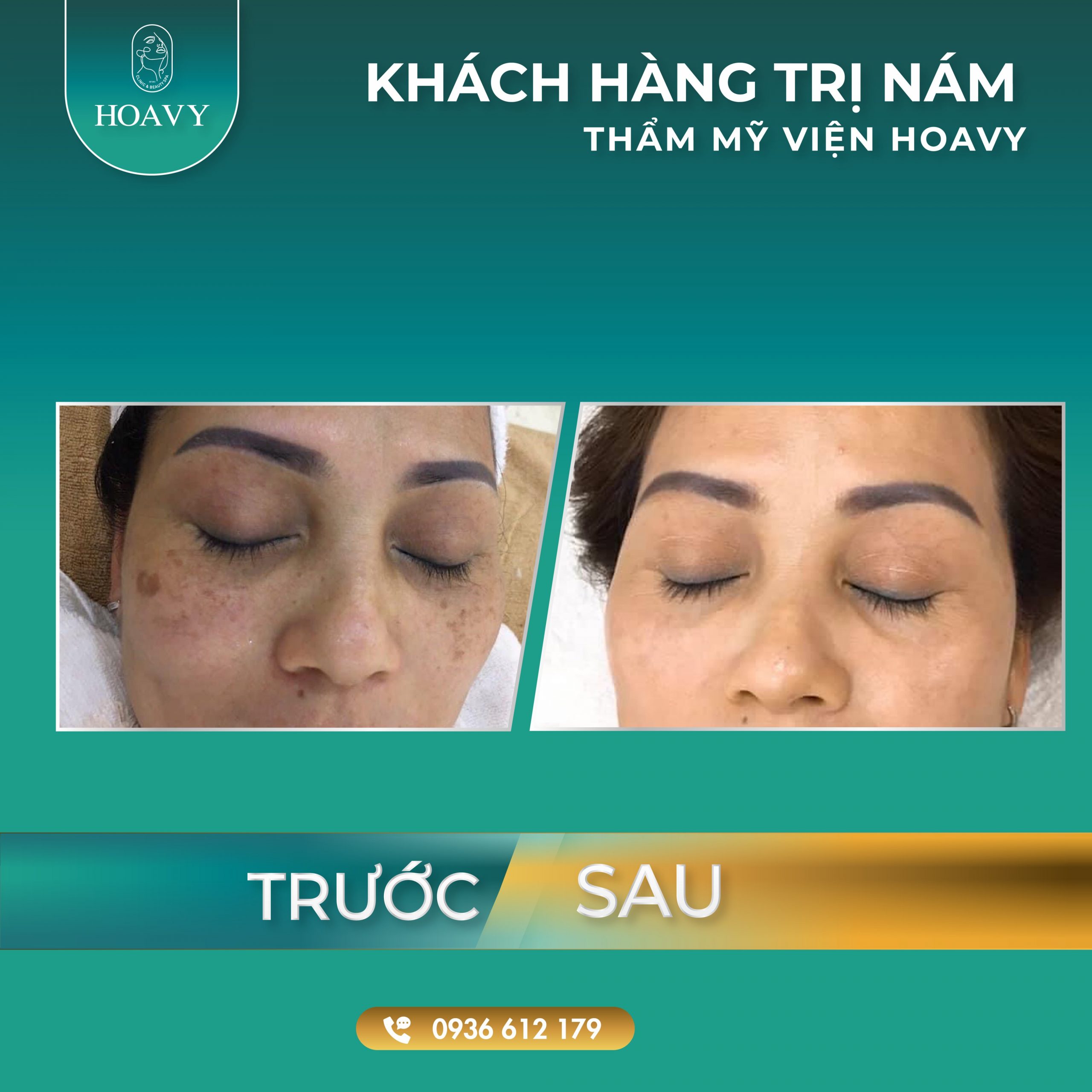 thammyhoavy.vn- hinh anh khach hang lam dep tai hoa vy hai phong quang ninh- tri nam