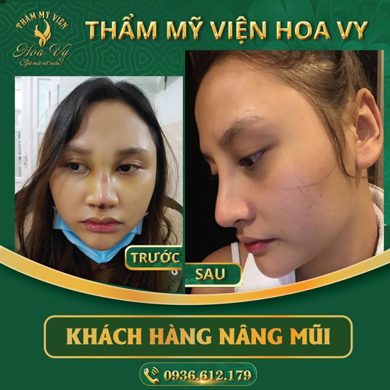 Chi phí nâng mũi tại Hải Phòng 1 chi phi nang mui