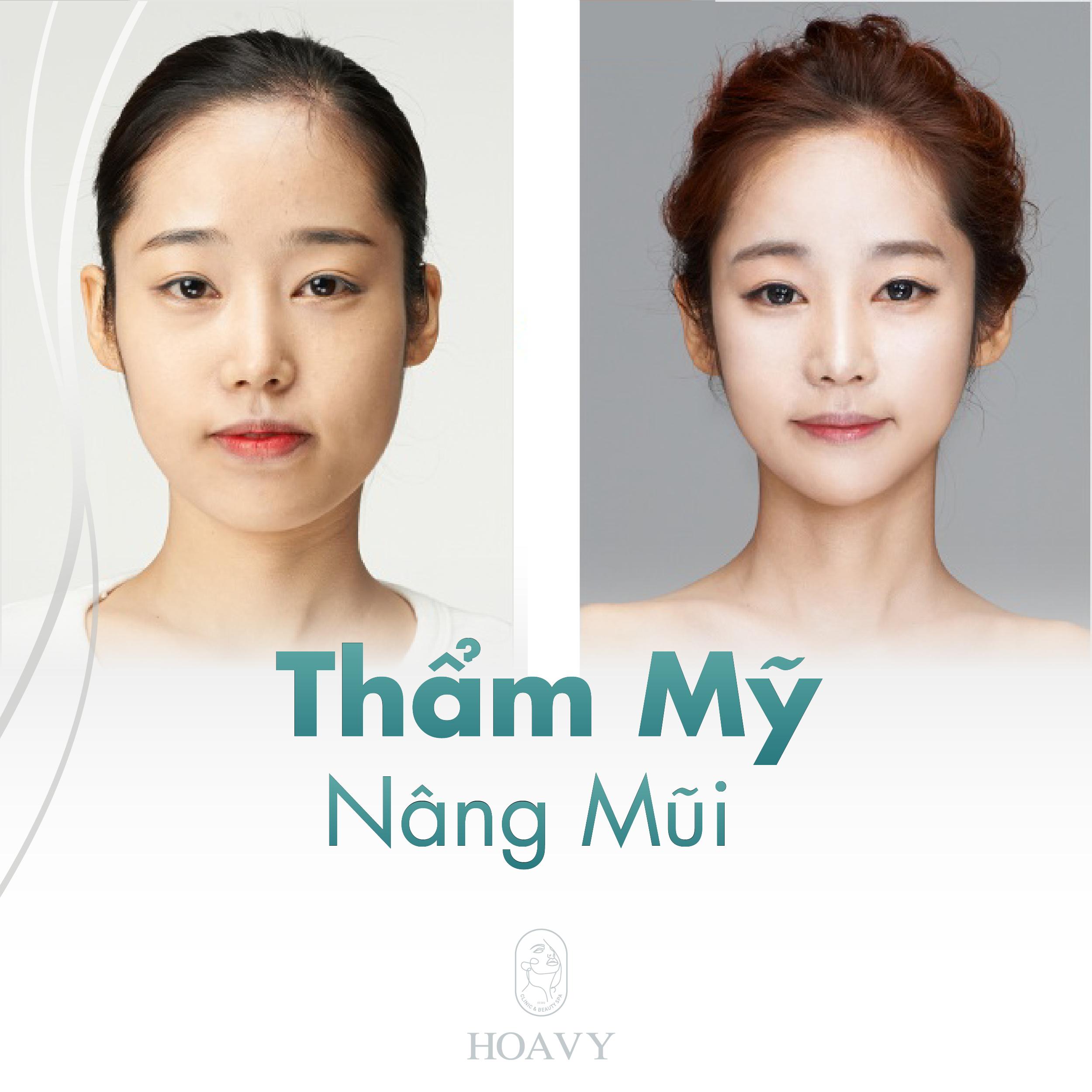 thammyhoavy.vn- tham my nang mui tai hai phong- tham my nang mui tai quang ninh