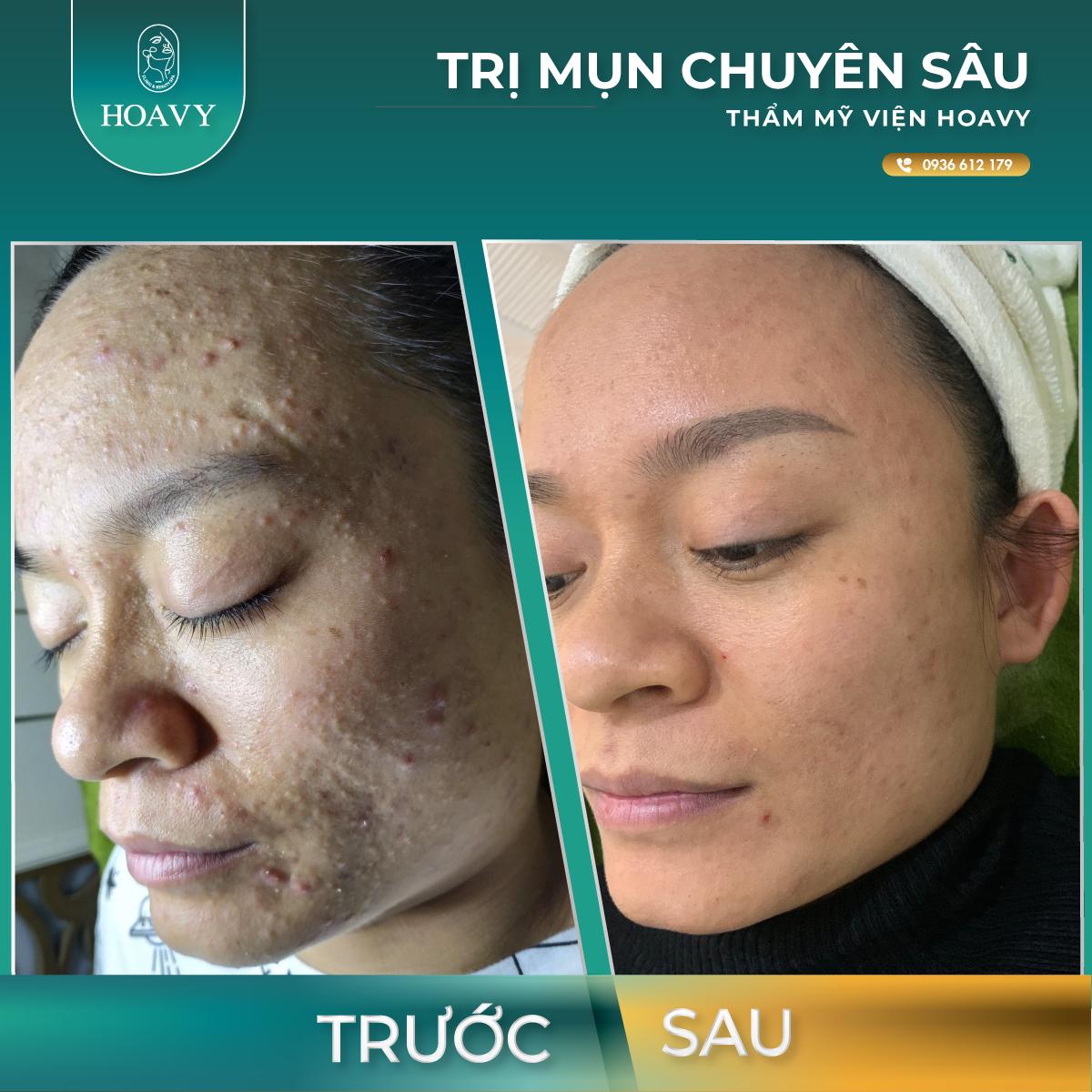 thammyhoavy.vn tri mun tai hai phong tri mun tai quang ninh tri mun tan goc hieu qua hoavy spa