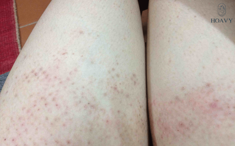 Hậu quả của triệt lông triet long triet long tai hai phong triet long nach triet long chan triet long mat triet long bikini triet long vinh vien triet long tai nha triet long tai tham my vien nguyen tac triet long