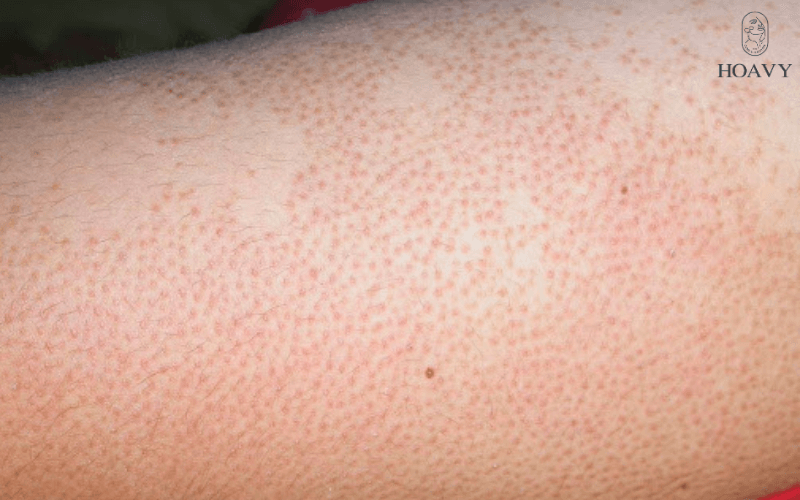 Hậu quả của triệt lông triet long triet long tai hai phong triet long nach triet long chan triet long mat triet long bikini triet long vinh vien triet long tai nha triet long tai tham my vien nguyen tac triet long