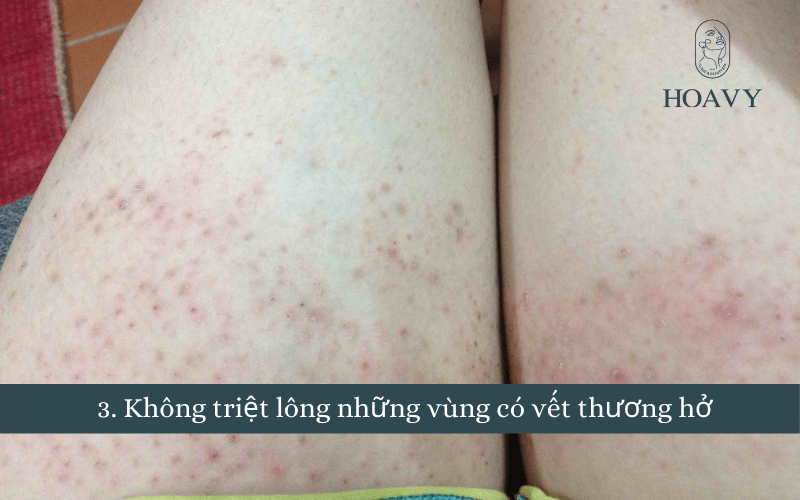 Triệt lông an toàn, triệt lông vĩnh viễn, nguyên tắc triệt lông triet long an toan triet long vinh vien triet long tay triet long chan triet long tai hai phong