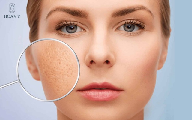 Lợi ích của triệt lông mặt triet long mat