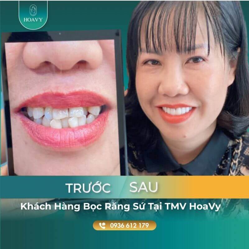 Chi phí răng bọc sứ trên thị trường hiện nay rất đa dạng