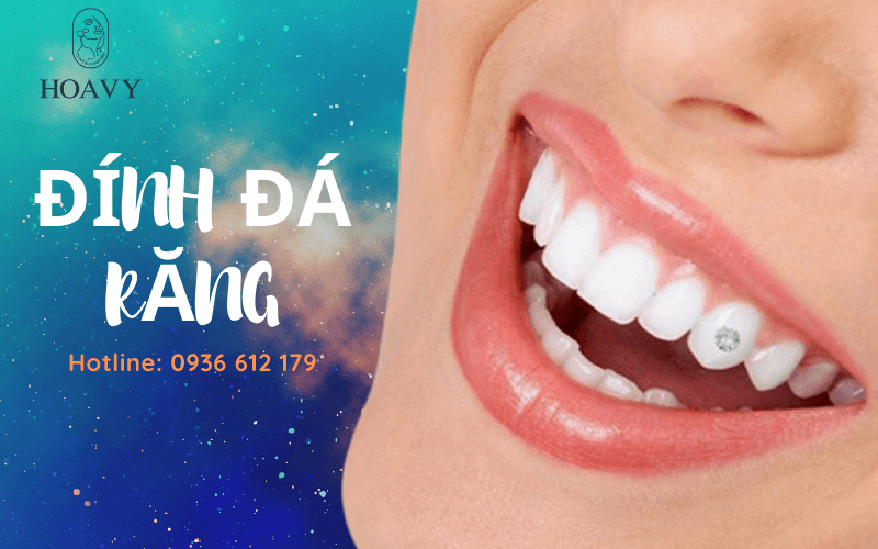 dich vu dinh da rang dinh da rang tai hai phong dinh da rang gia re tham my rang nha khoa tham my dinh da rang o dau gia re