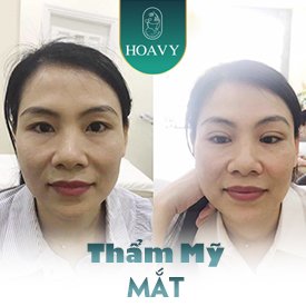 thẩm mỹ mắt tại Hải Phòng