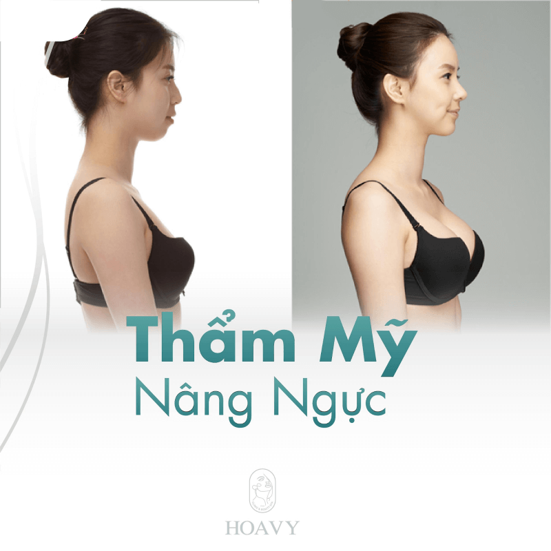 Vòng 1 căng tròn sau khi nâng ngực tại Hoa Vy 