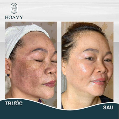 Công nghệ Laser Helios III rất an toàn cho làn da 