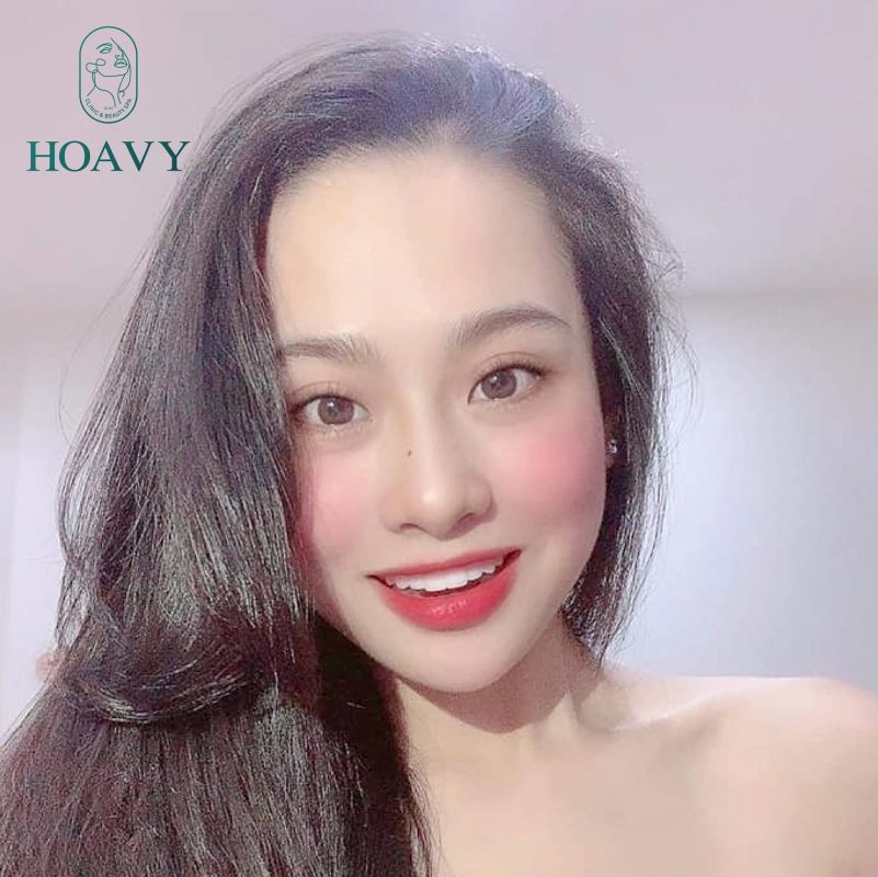 Những lưu ý trước và sau khi tiêm filler môi baby 1 Những lưu ý trước và sau khi tiêm filler môi baby