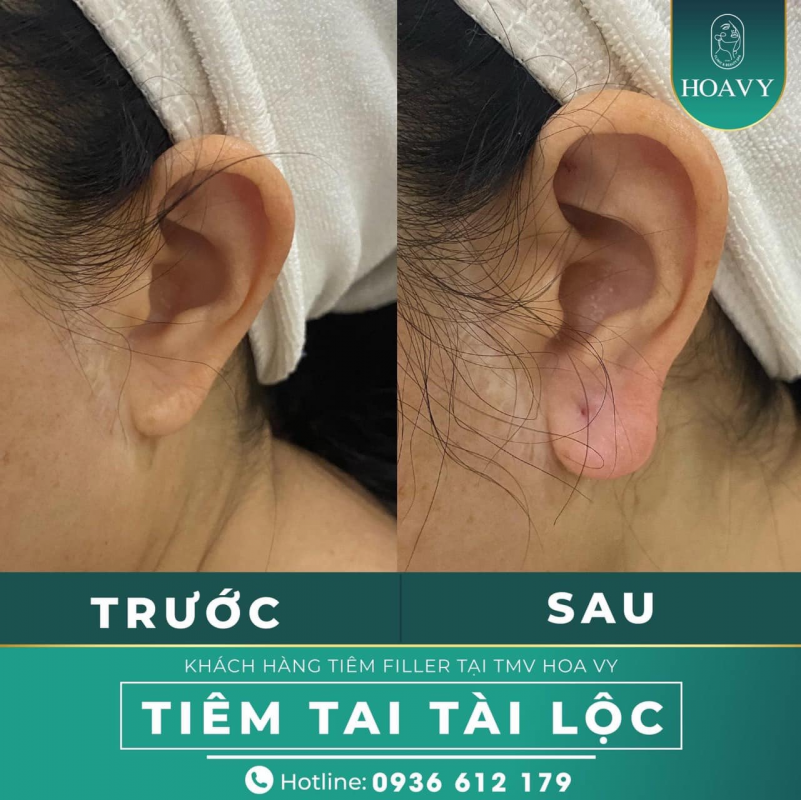 Tiêm tai tài lộc là xu hướng mới được khách hàng đánh giá cao 
