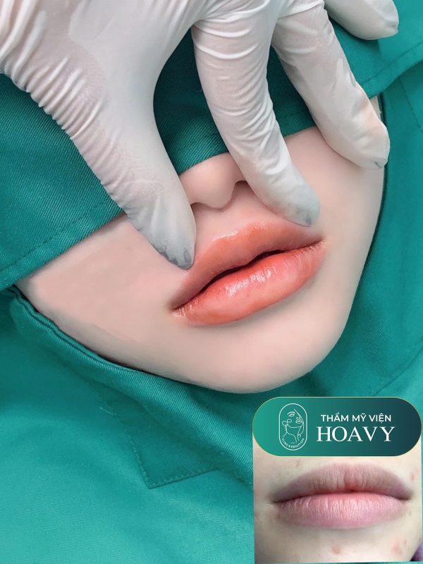 Phun môi thẩm mỹ - hoá giải những hiểu lầm thường gặp 1 Phun môi thẩm mỹ là phương pháp làm đẹp được ưa chuộng tại Hải Phòng