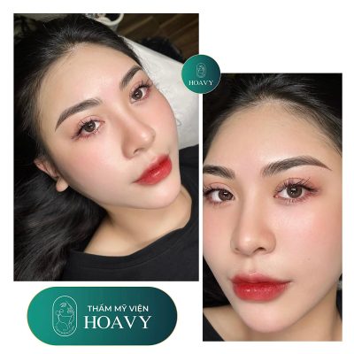 phau thuat nang mui 4