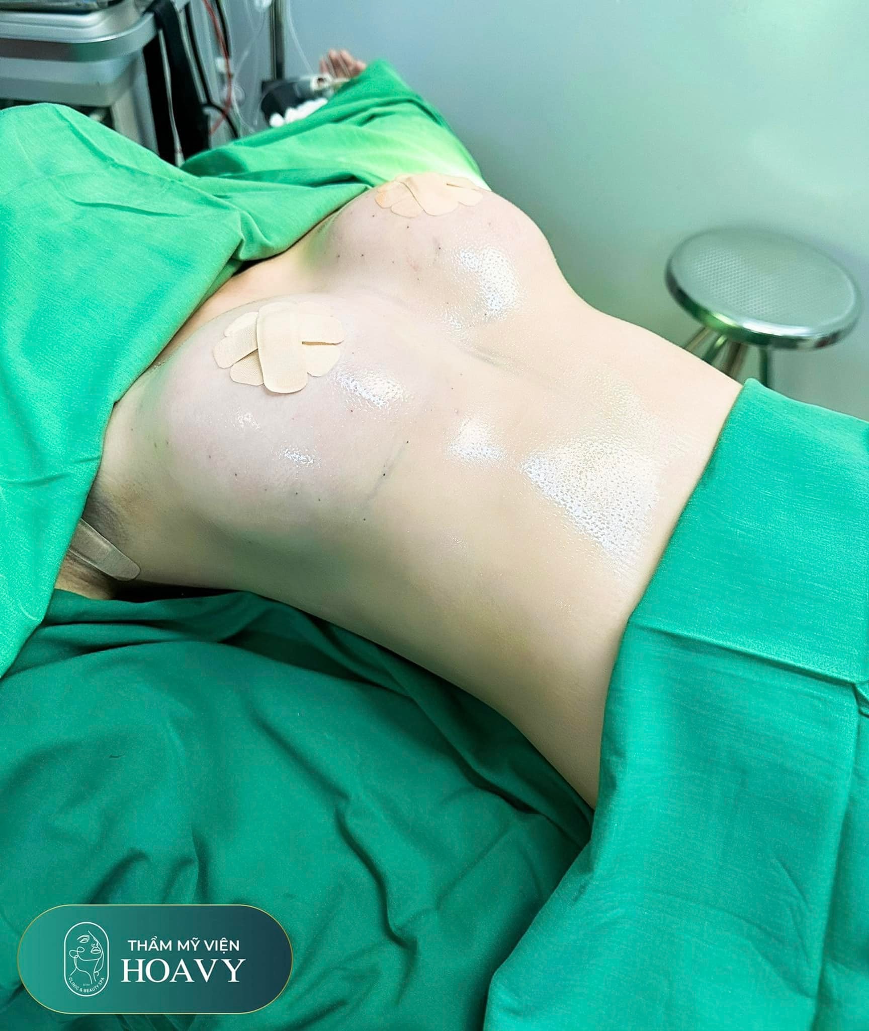 Vòng ngực sau khi cấy mỡ tự thân sẽ được cải thiện kích thước nhưng vẫn giữ độ mềm mại tự nhiên