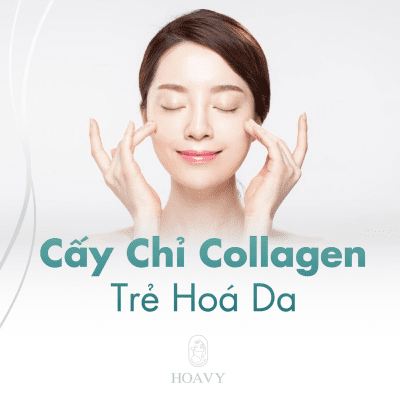 Cấy chỉ Collagen giúp trẻ hoá da hiệu quả