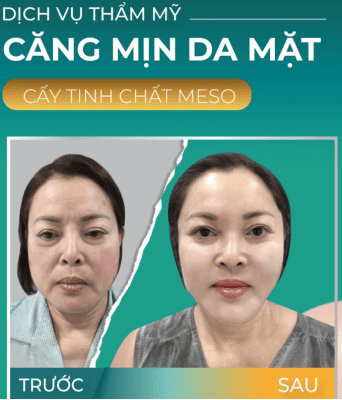 cay meso cang bong da