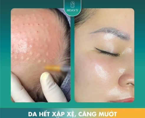 cay meso extra khong kim 5