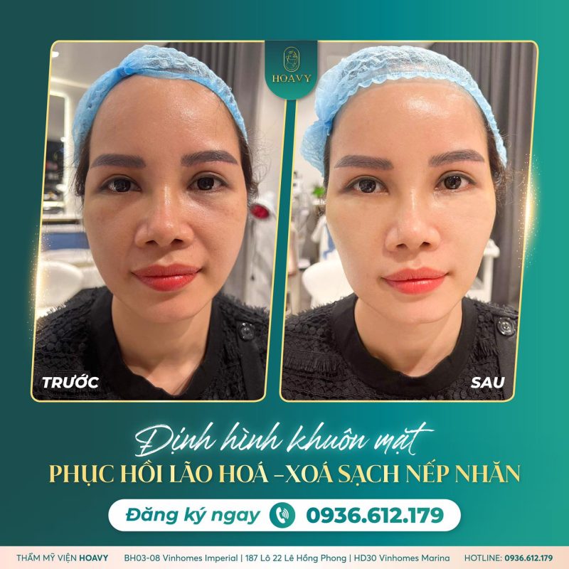 phuong phap vi cay collagen duoi da