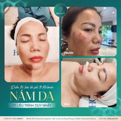 tri nam da bang cong nghe laser helios iii