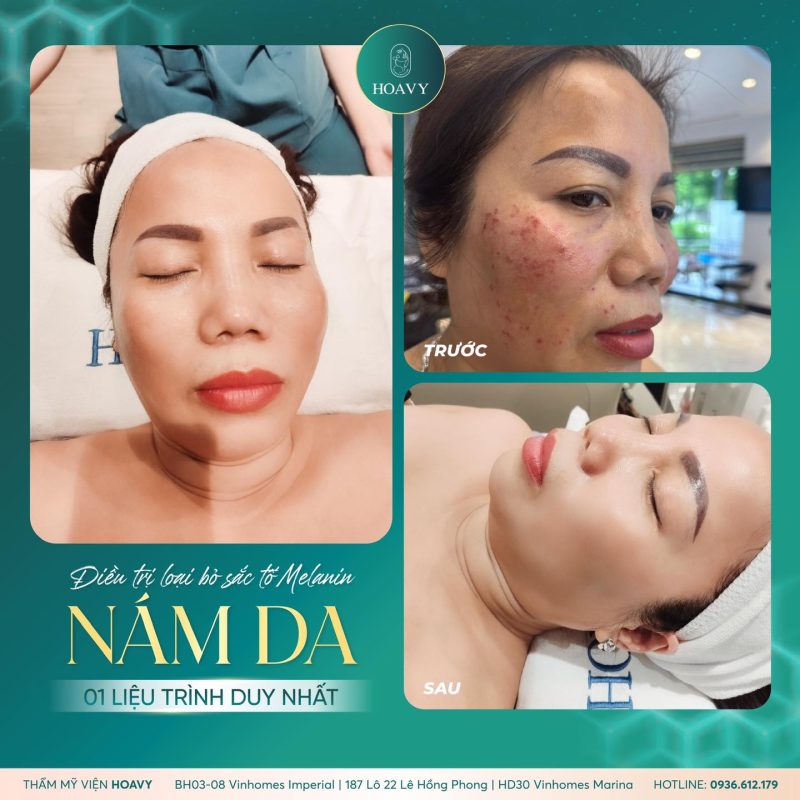 tri nam da bang cong nghe laser helios iii