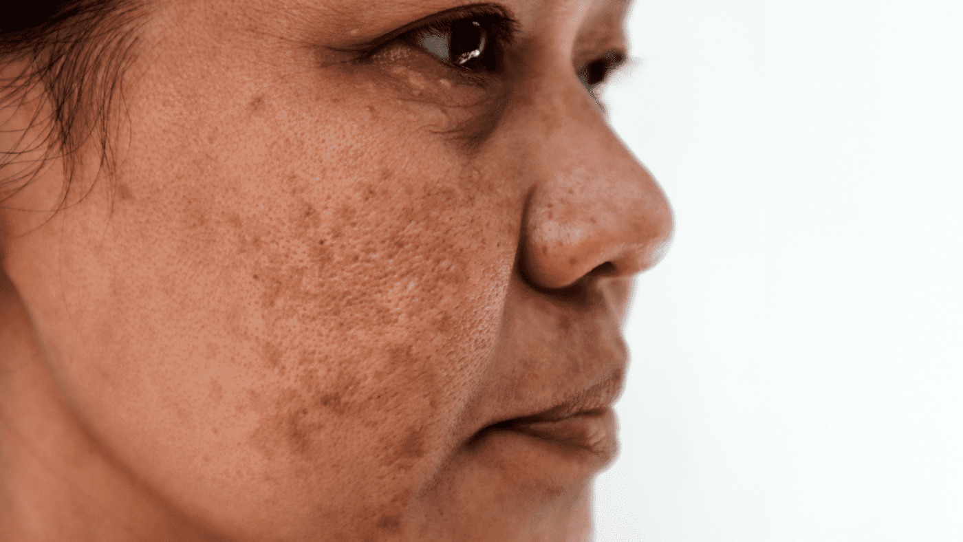 Tổng hợp phương pháp điều trị sạm nám công nghệ cao 1 dieu tri sam nam