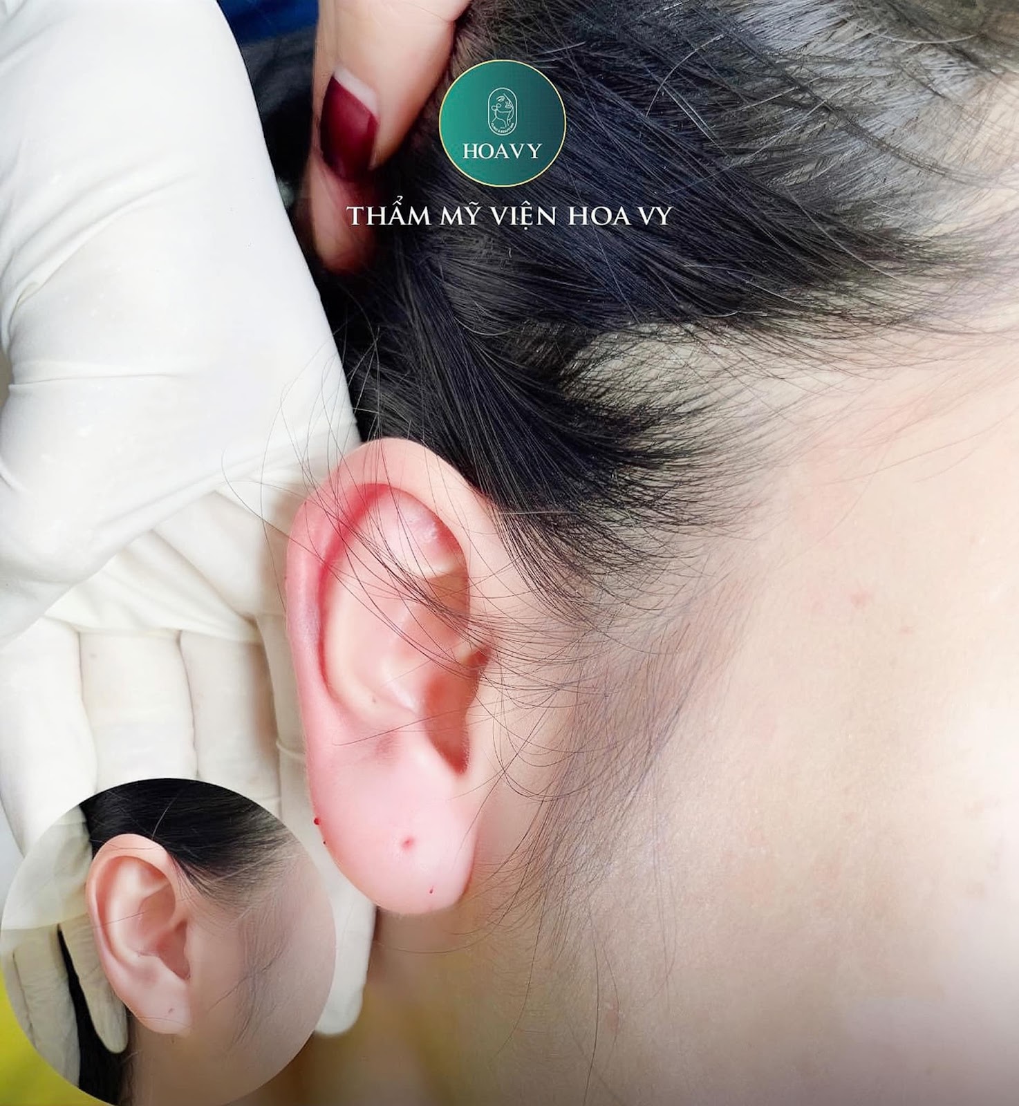 Một ca tiêm tai tài lộc thành công cho dáng tai đẹp như ý 