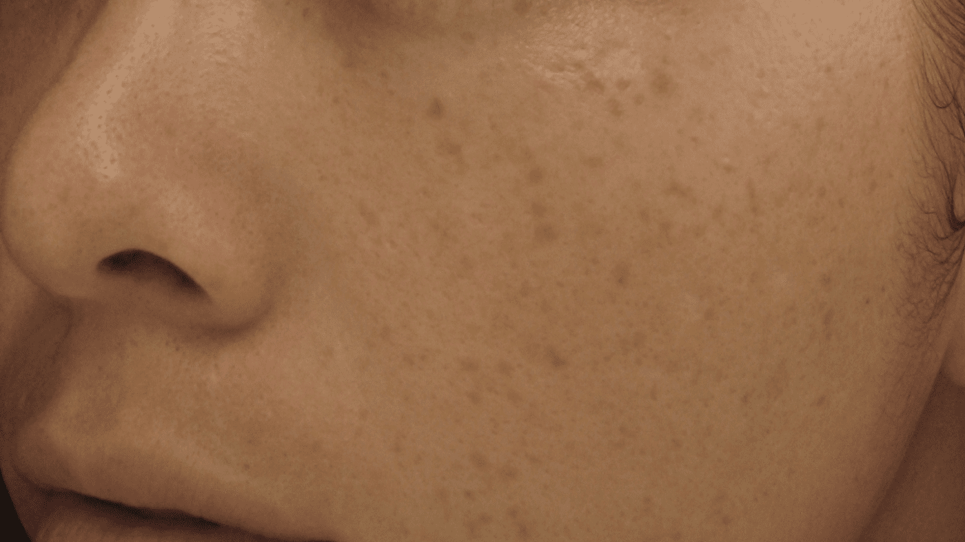 Đốt tàn nhang gây sẹo lõm: sự thật hay chỉ là tin đồn? 1 dot tan nhang