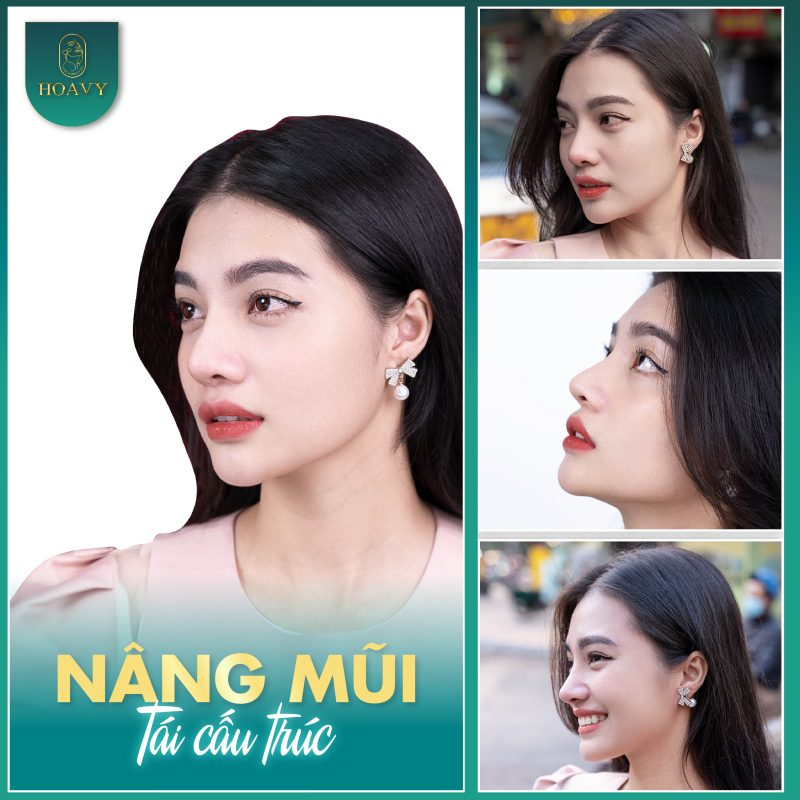 Giải đáp loạt thắc mắc liên quan đến nâng mũi bọc sụn 1 nang mui boc sun