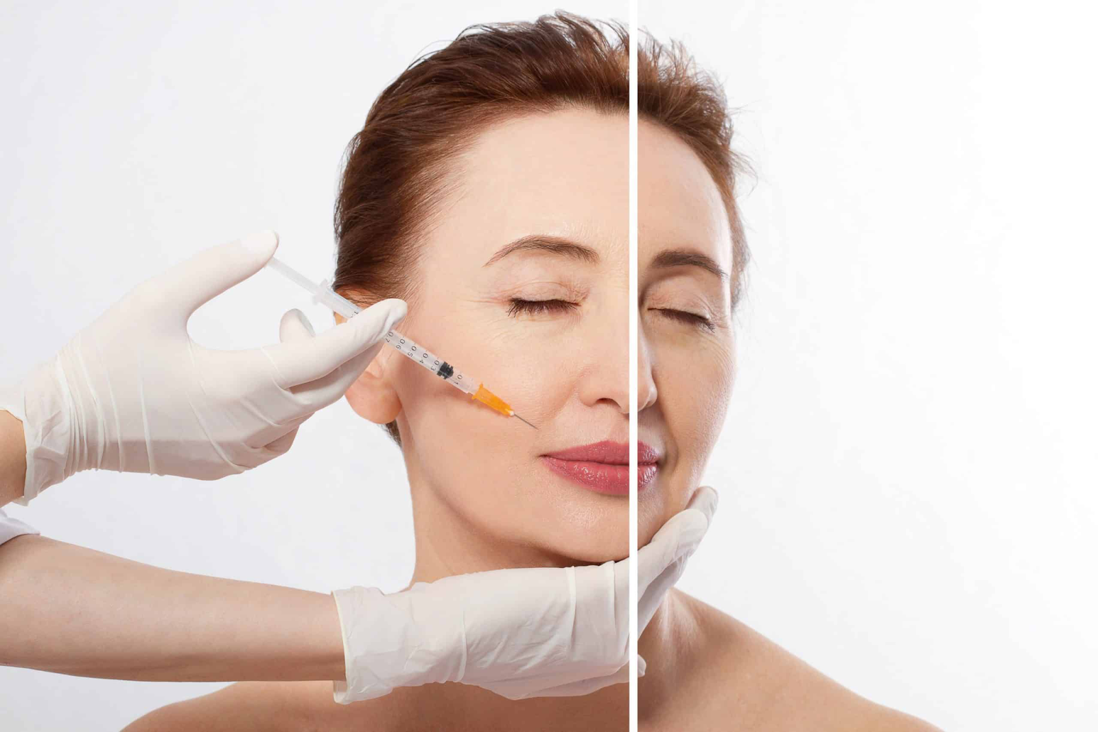 Tiêm filler có tác dụng “làm đầy” trong khi tiêm botox có xu hướng làm giãn cơ chống nếp nhăn 
