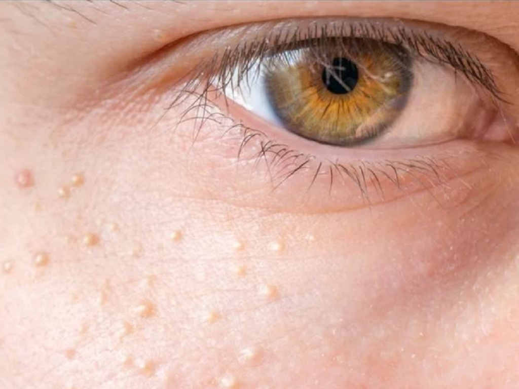 Làm cách nào để trị mụn thịt dứt điểm không để lại sẹo? 1 tri mun thit