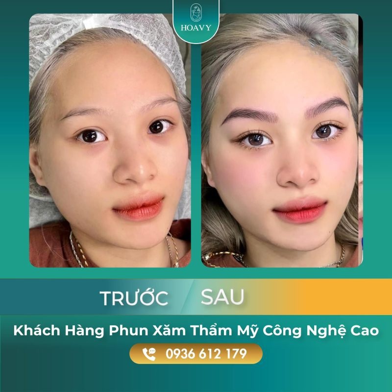 Thẩm Mỹ Hoa Vy - Địa chỉ khắc phục phun mày bị hư hiệu quả