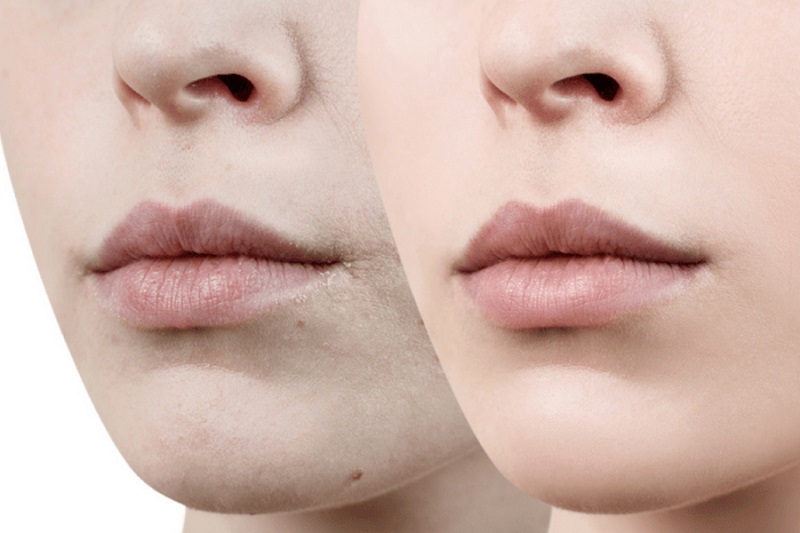 Khử thâm môi bao lâu thì lên màu luôn được quan tâm