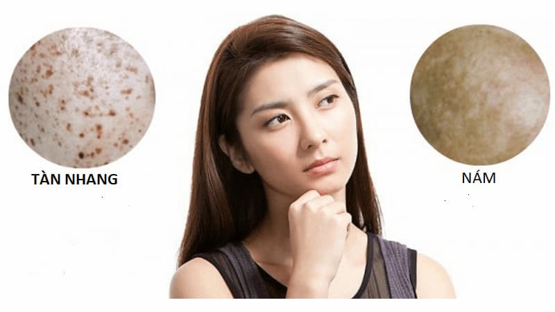 Cách nhận dạng nám và tàn nhang chuẩn & cách điều trị 1 Cách nhận dạng nám và tàn nhang chuẩn & cách điều trị