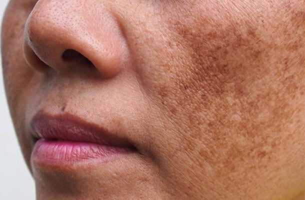 Bị tàn nhang lâu năm có thể điều trị dứt điểm hay không?