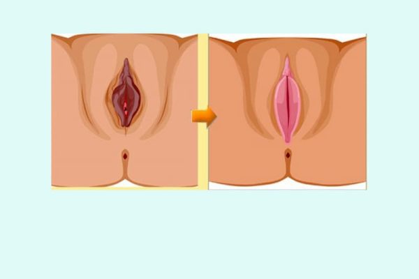 Thẩm mỹ vùng kín có bị đau hay không? Địa chỉ thực hiện uy tín