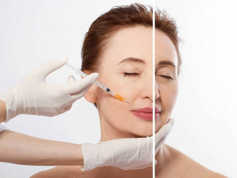 5 ưu điểm cấy collagen Type 3 trẻ hoá căng bóng da