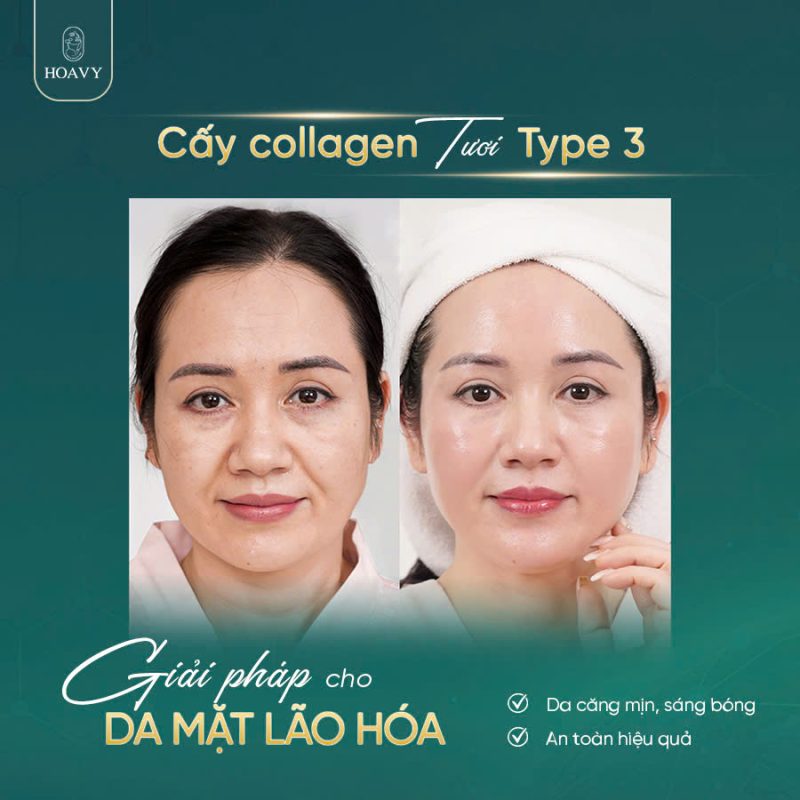 Căng da mặt không phẫu thuật – Làn da trẻ hóa, đẹp tự nhiên không dao kéo 5 Căng da mặt không phẫu thuật