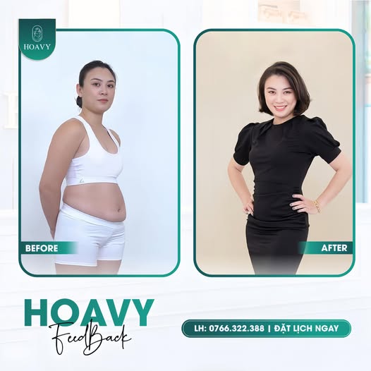 giảm mỡ không xâm lấn 14