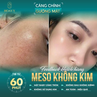 Căng da mặt Hải Phòng