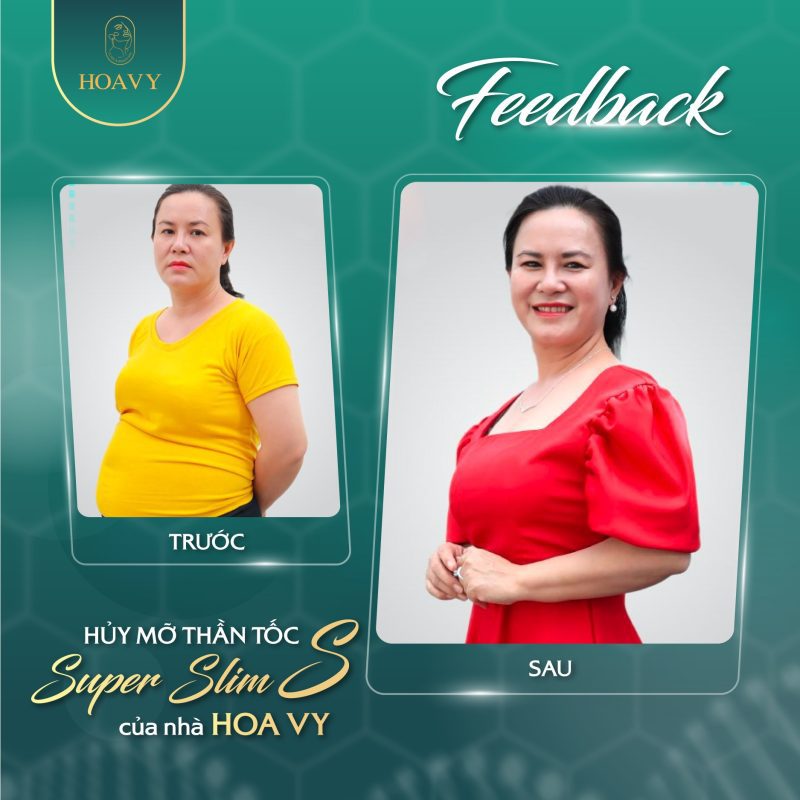 Hiệu quả hút mỡ bụng tại TMV Hoa Vy