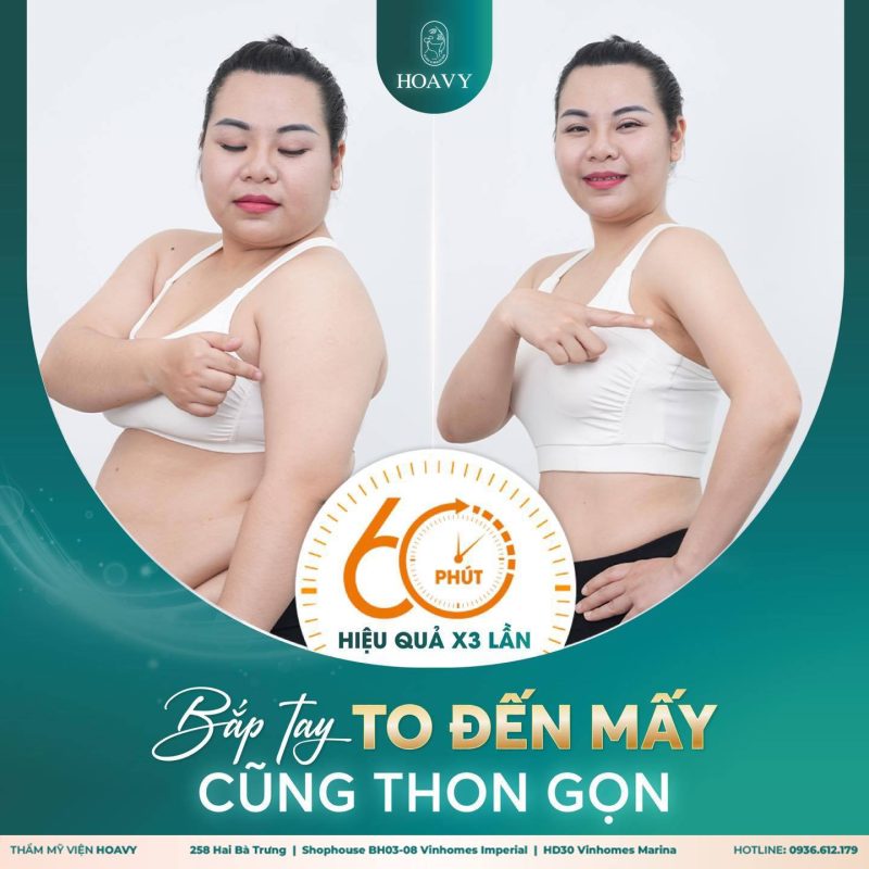 Giảm mỡ bụng Hải Phòng: Siết gọn vòng eo chỉ sau 60 phút tại Thẩm mỹ viện Hoa Vy 1 giảm mỡ bụng Hải Phòng