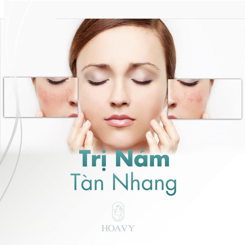 trị nám hải phòng