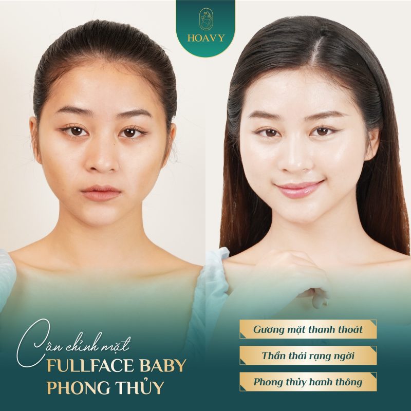 Cân chỉnh mặt Hải Phòng Fullface Baby phong thủy – Gương mặt hài hòa, hợp tướng số 6 Cân chỉnh mặt Hải Phòng tại Thẩm mỹ viện Hoa Vy - Điều chỉnh cấu trúc tổng thể - trán, mũi, cằm, gò má, đường viền hàm.